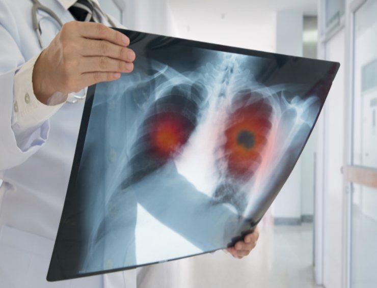 tumore ai polmoni fattori di rischio, sintomi 
