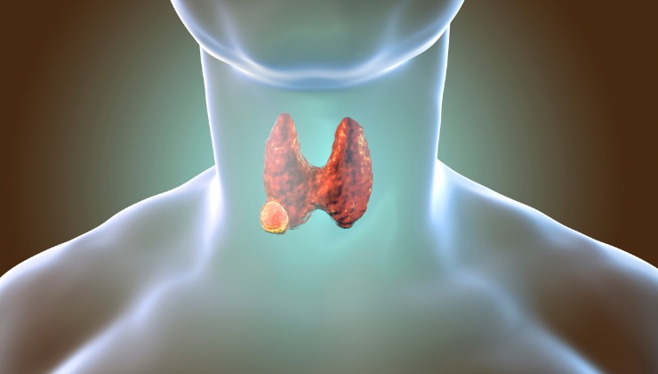 Tumore alla tiroide: il primo sintomo 