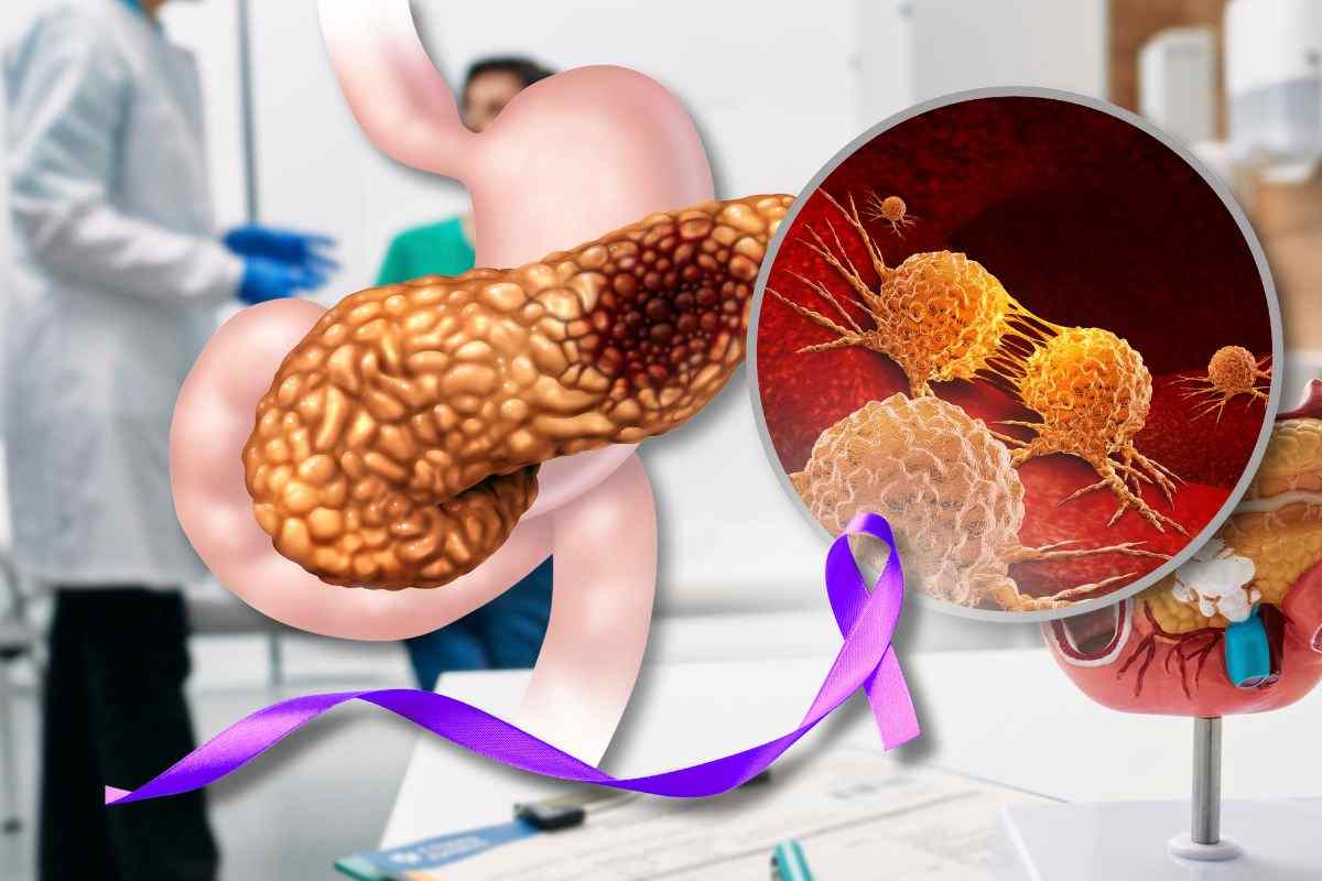 Tumore al pancreas, sintomi iniziali