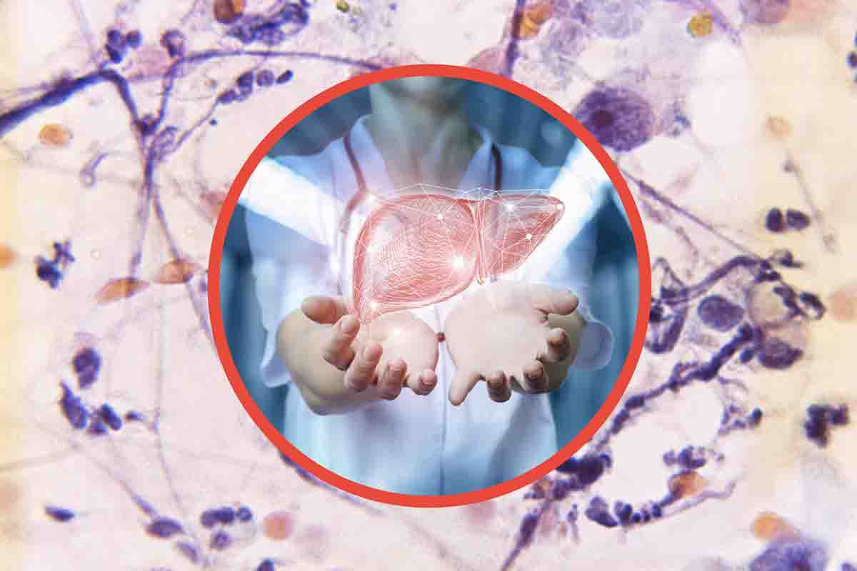 Quali sono i sintomi di un tumore al fegato?