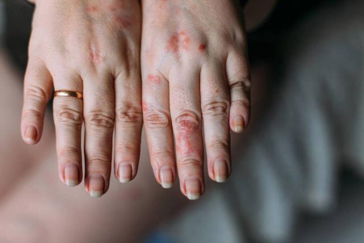 segni rossi mani infezione grave