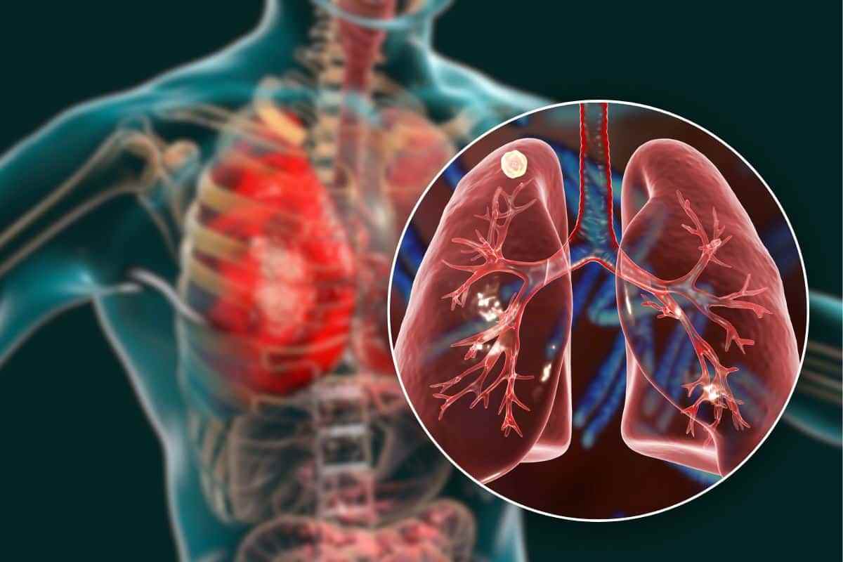 Tumore ai polmoni sintomi si confondono