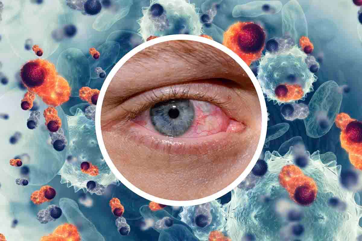 Tumore all'occhio: sintomi, prevenzione, cause