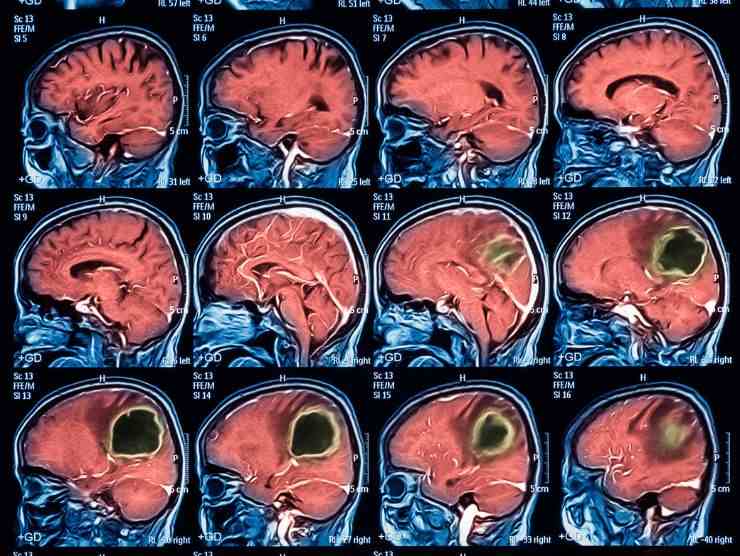 Mal di testa e problemi di vista possono essere sintomi di un tumore