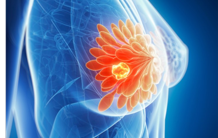 I primi segnali del tumore al seno: attenzione alla diagnosi 
