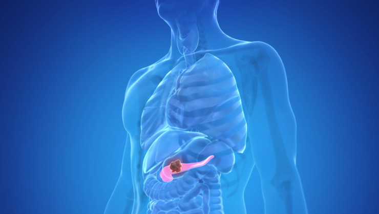 Attenzioni a questi sintomi: potrebbero rivelare un cancro al pancreas