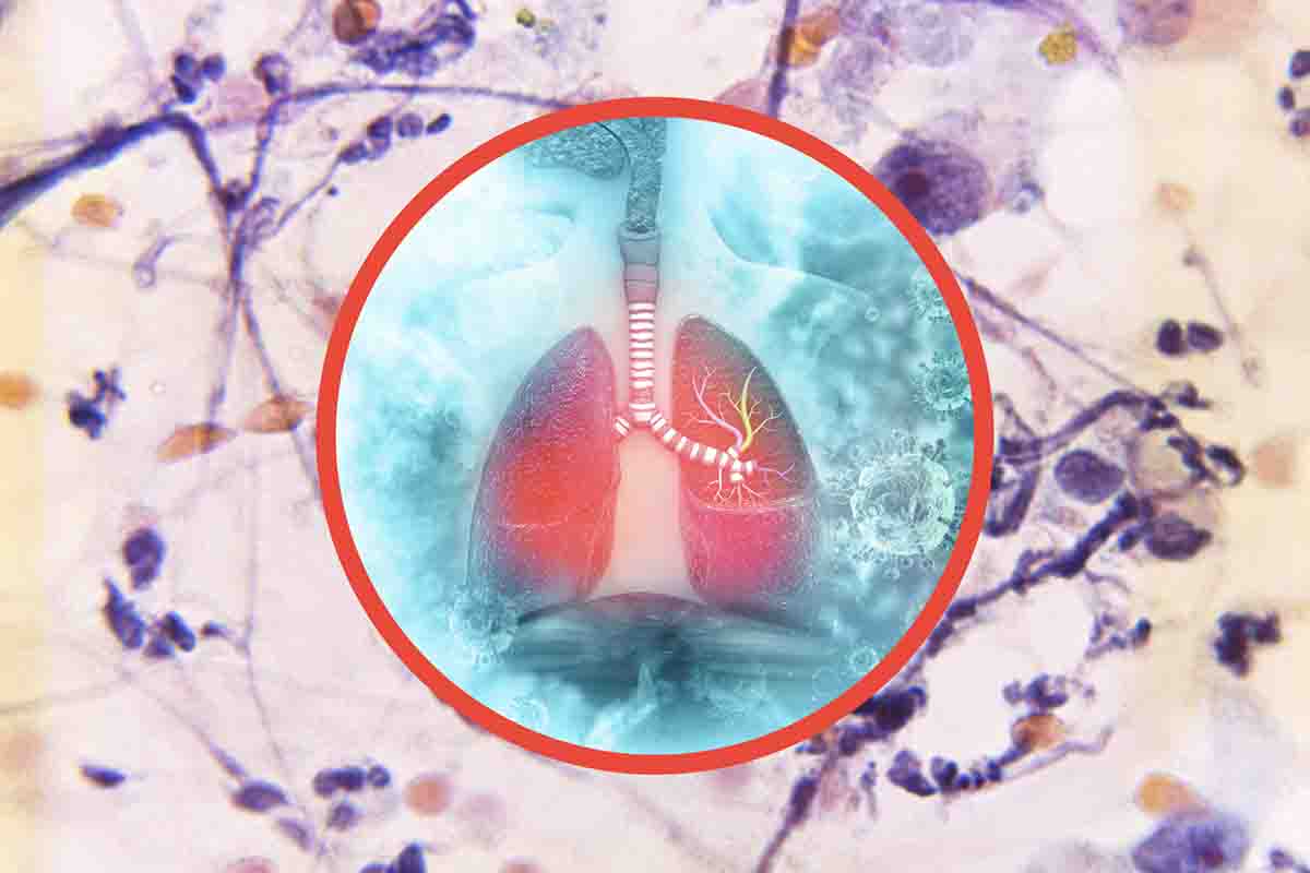 Tumore ai polmoni, un nuovo farmaco fa sparire la malattia