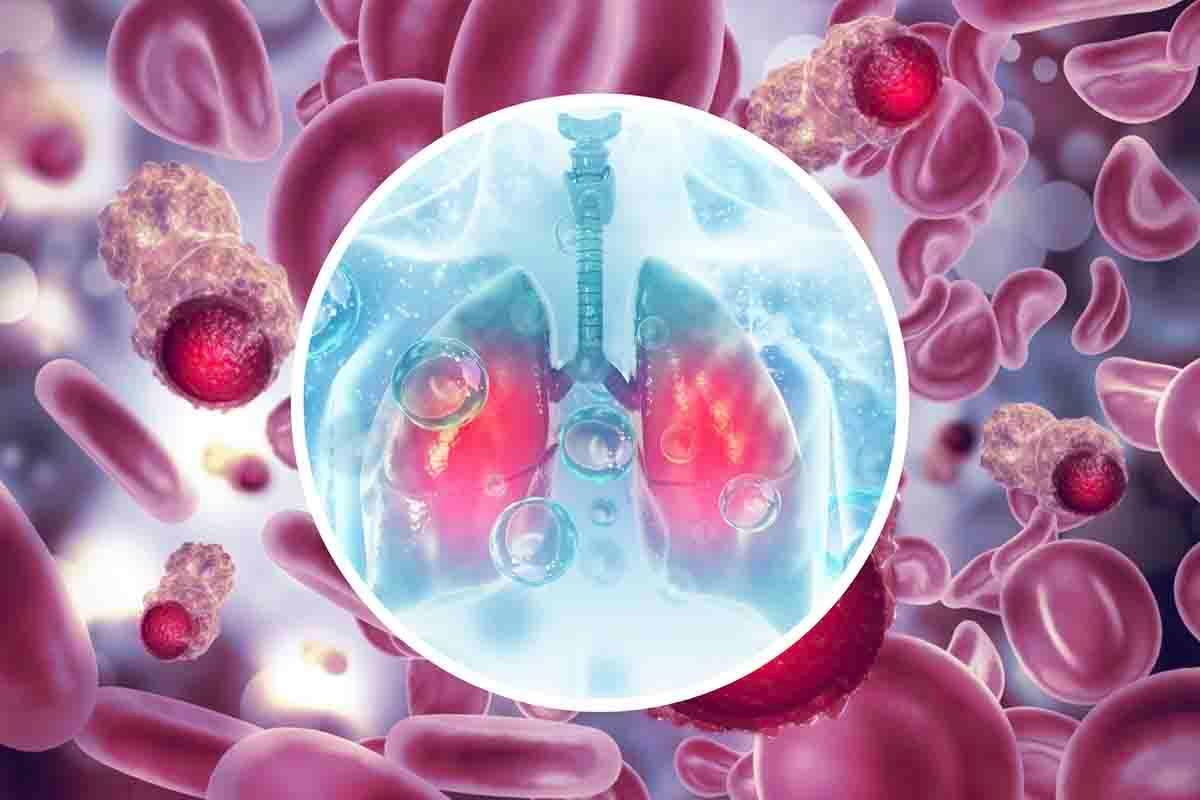 Tumore polmone sintomi silenziosi