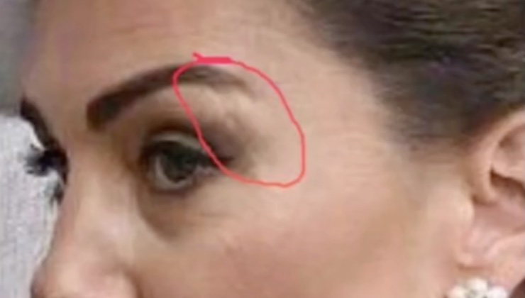 Ecco le immagini della cicatrice sul volto di Kate 