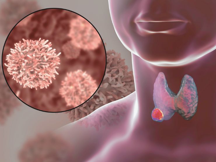 Tumore alla tiroide, il sintomo non ignorabile