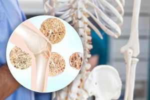 Osteoporosi, L’allerta Dei Medici: Abbiamo Sempre Sbagliato Modi E 