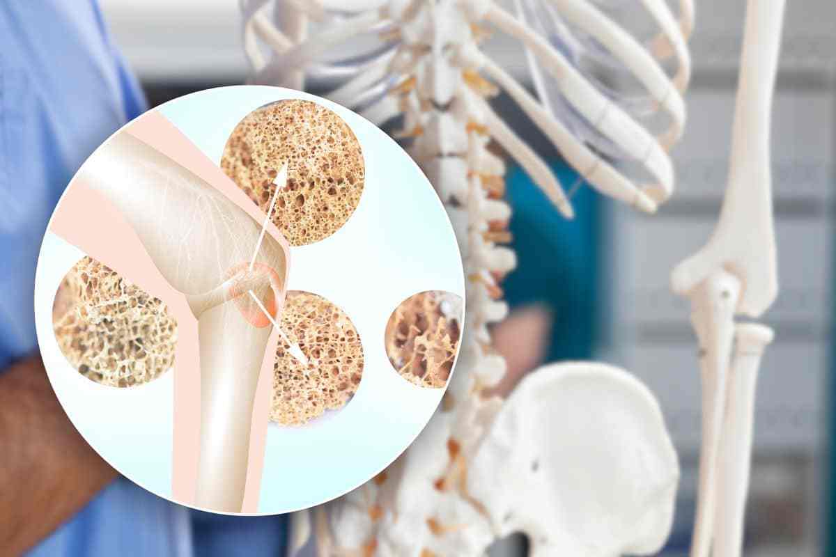 prevenzione osteoporosi