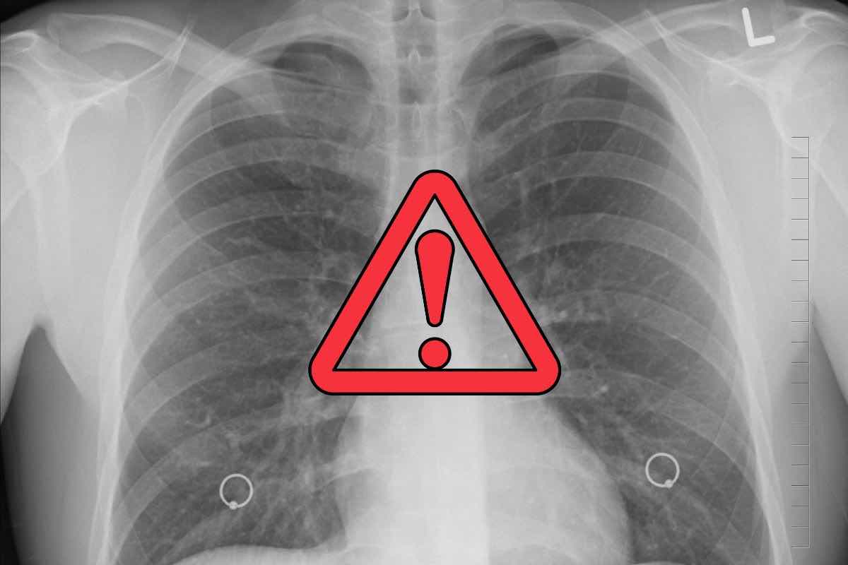 Polmoni sintomi da non sottovalutare