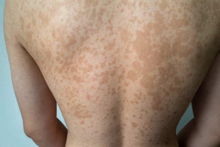 Come risolvere il problema delle macchie rosse sul corpo