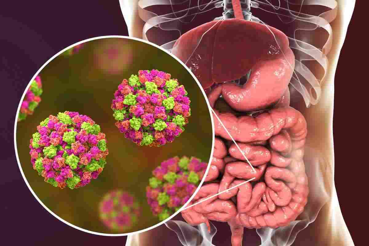 Sintomi e cura Norovirus